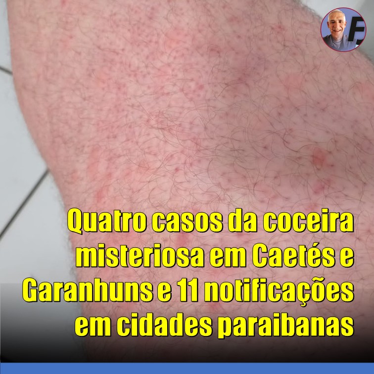COCEIRA | Notificações em Caetés e Garanhuns em Pernambuco, além de 11 casos suspeitos na Paraíba deixam autoridades de Saúde em alerta
