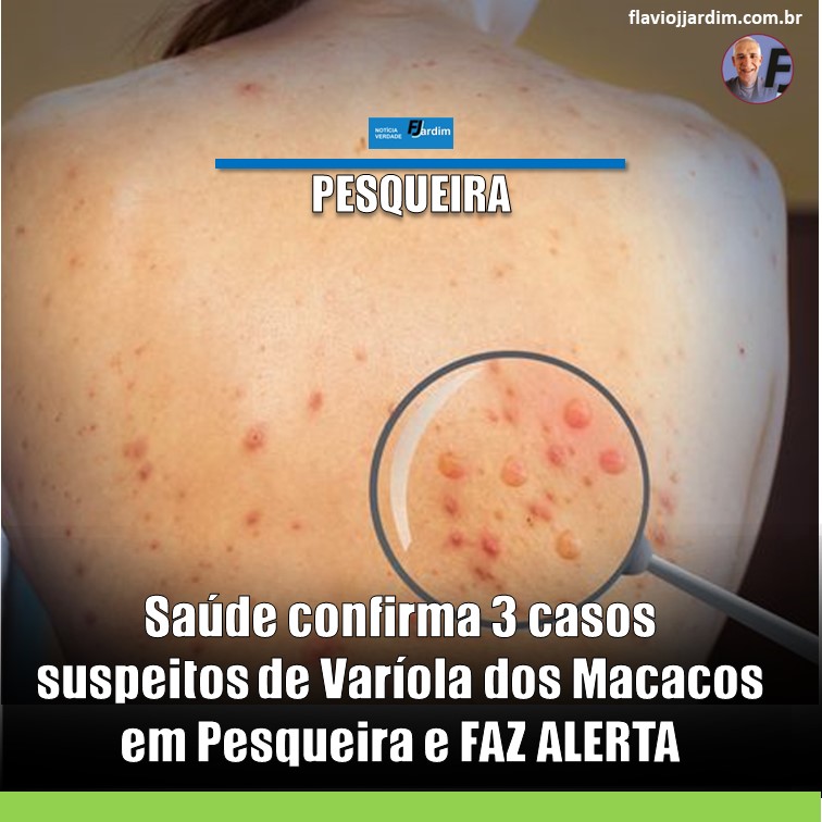 PACIENTES SUSPEITOS DE VARÍOLA DOS MACACOS EM PESQUEIRA | Secretaria Municipal de Saúde emite Nota Oficial