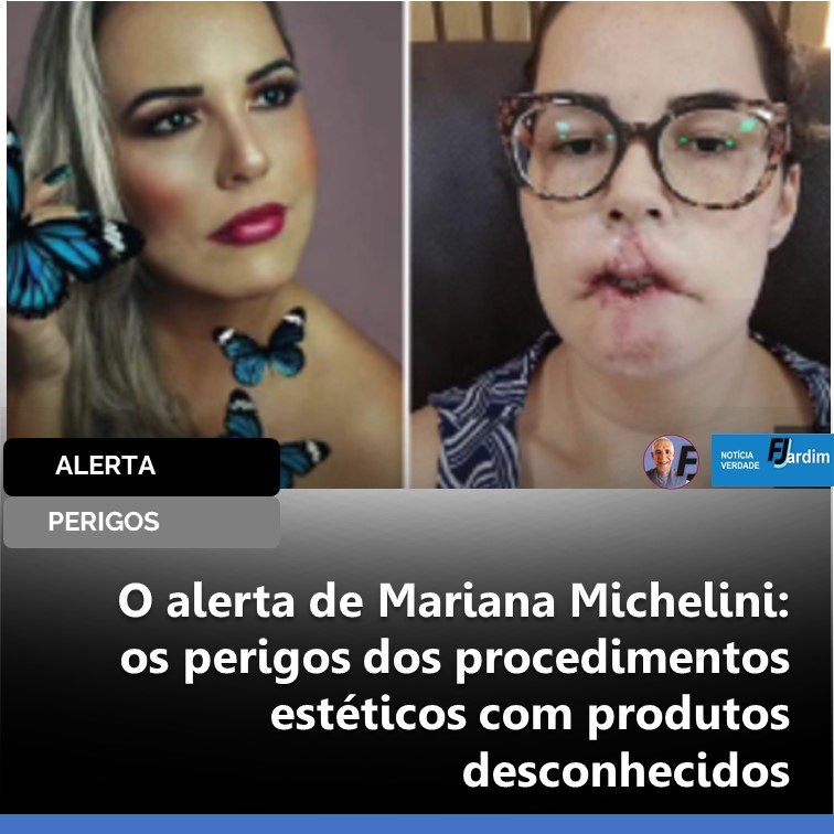 PERDEU O LÁBIO | O alerta de Mariana Michelini: os perigos dos procedimentos estéticos com produtos desconhecidos