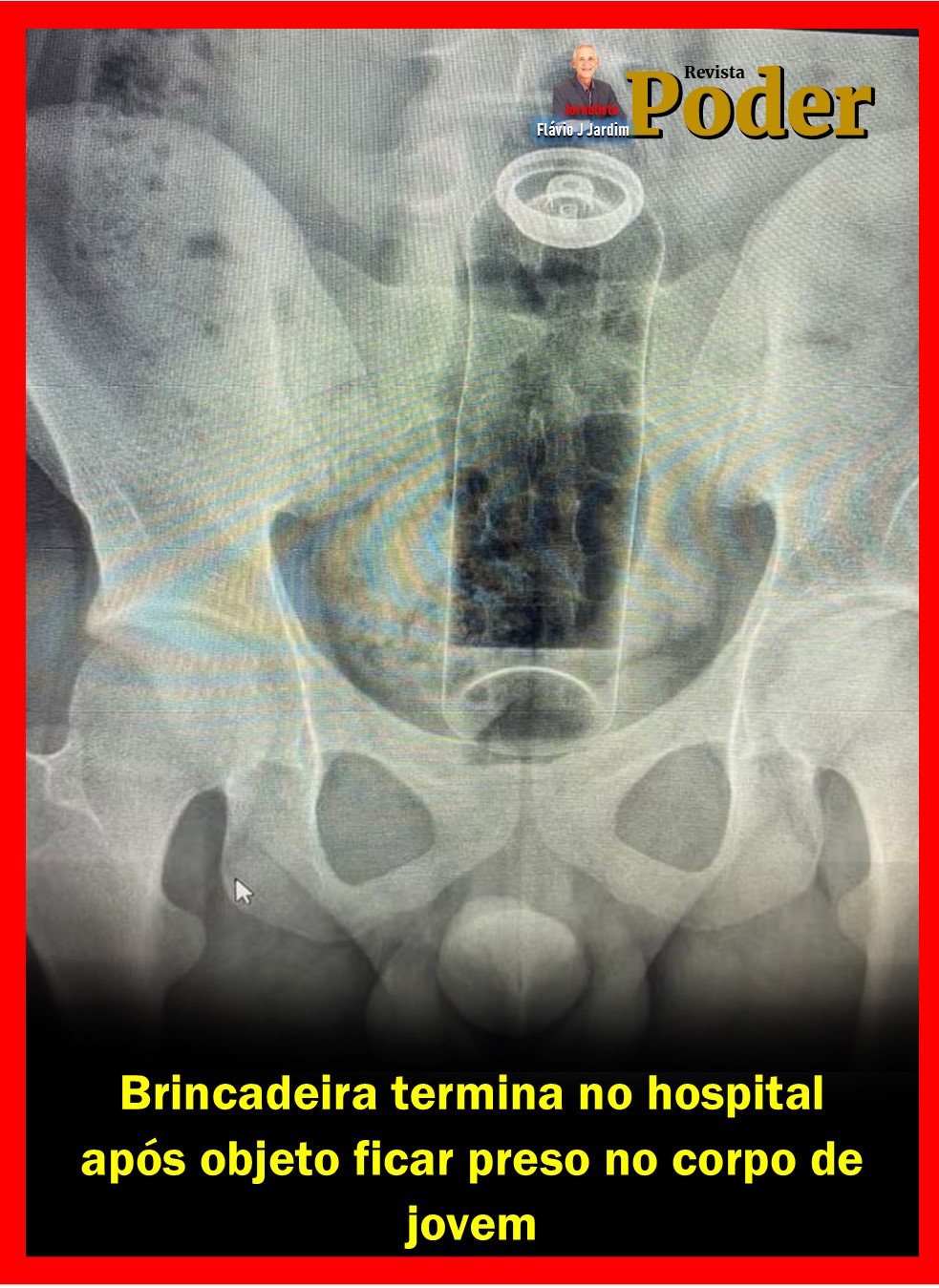 Brincadeira termina no hospital após objeto ficar preso no corpo de jovem