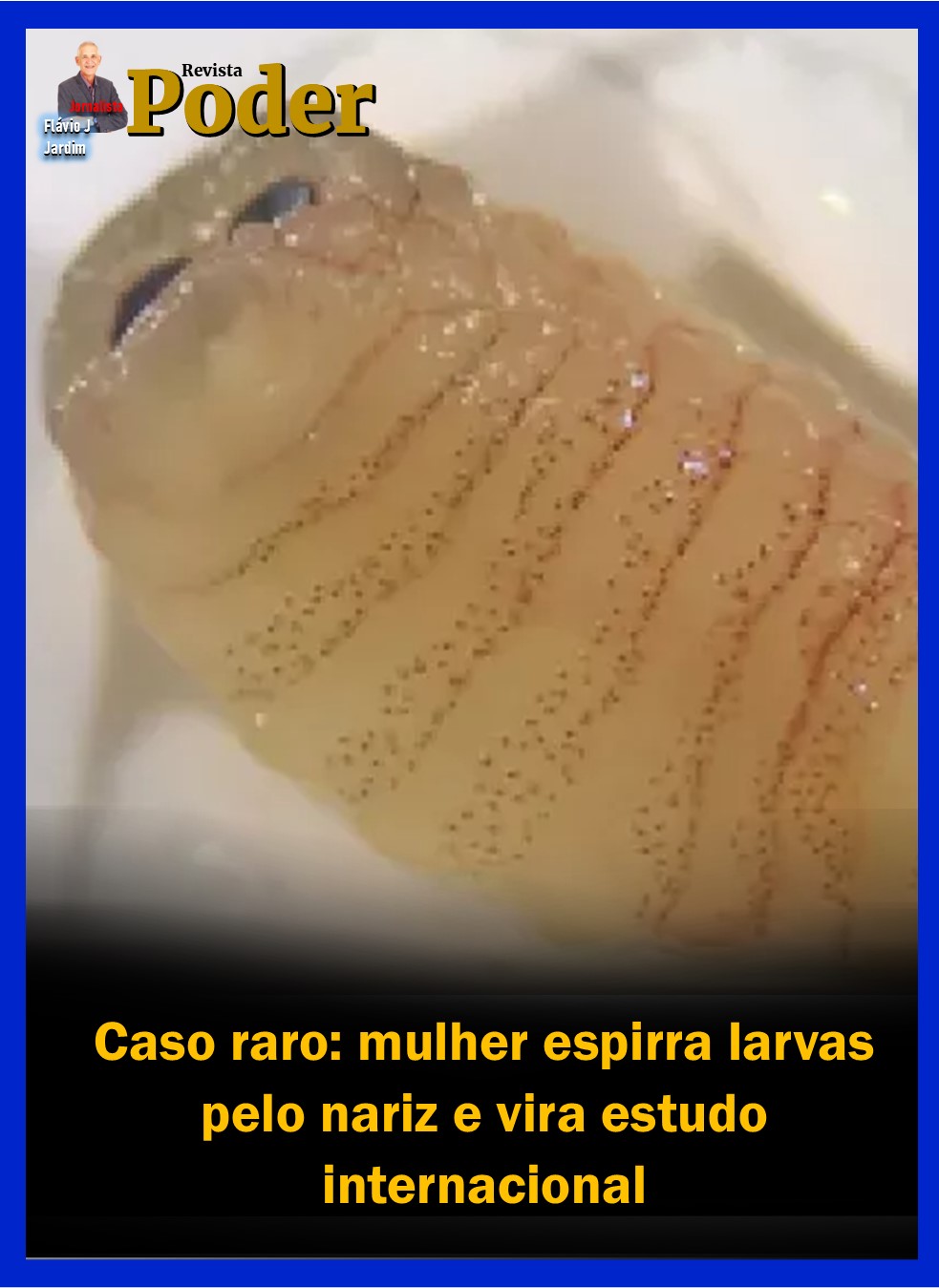 Caso raro: mulher espirra larvas pelo nariz e vira estudo internacional